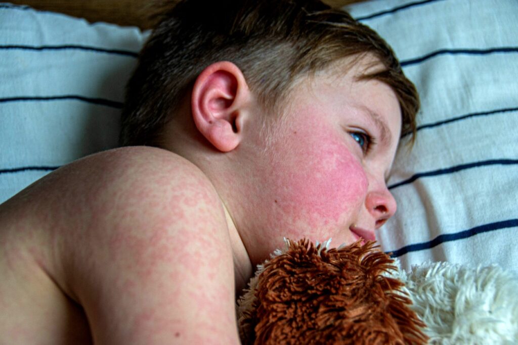 Parvovirus or ‘slapped cheek disease' is on the rise, says CDC, what to know